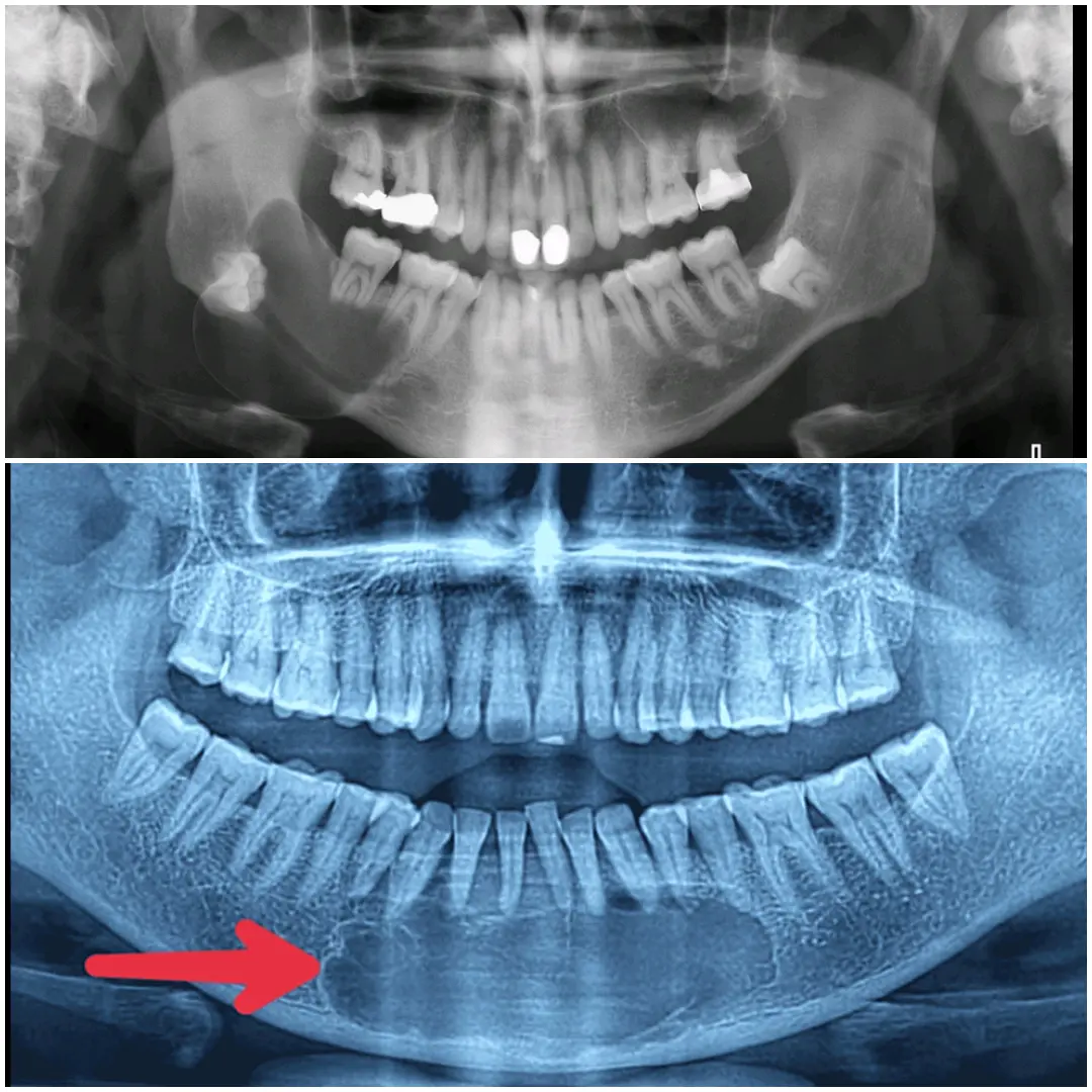 Jaw cysts and tumors treatment in Kolkata