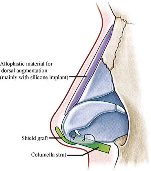 Rhinoplasty in Kolkata